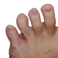 Pilz tëscht de Fangeren