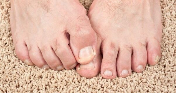 Symptomer vum Neel Pilz