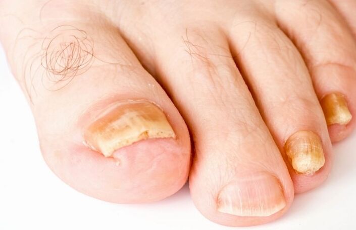 De Pilz um Daum vum Been