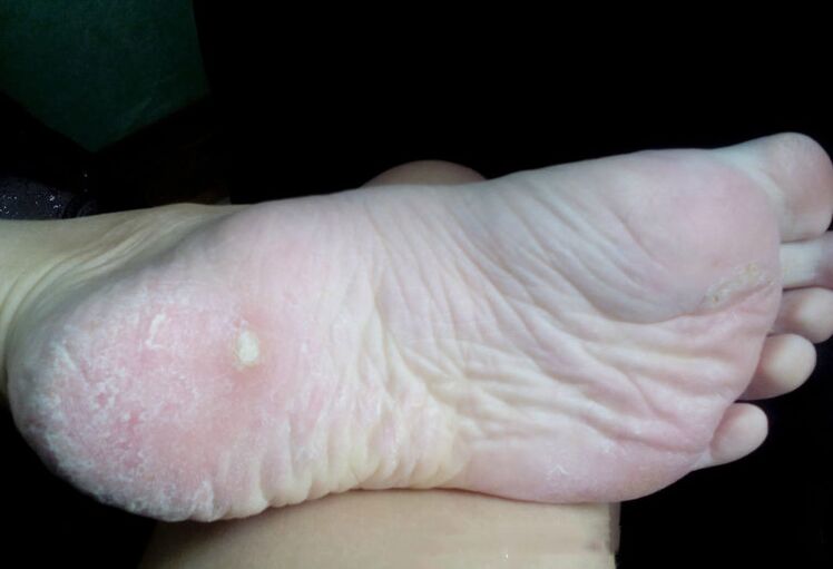 Behandlung vum Pilz mat engem Laser