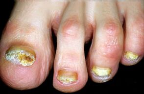 Charakteriséierung vun der Krankheet