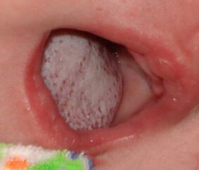 Lokaliséierung vun der Krankheet mat engem Pilz