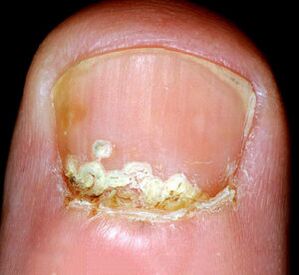 Symptomer a Schëlder vun der Krankheet