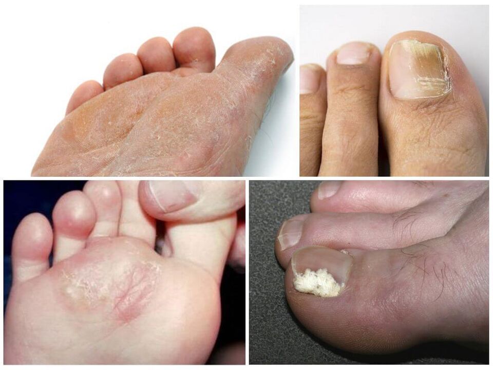 Déi éischt Stuf vum Fousspilz