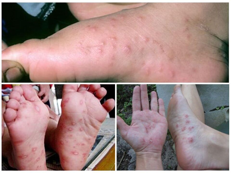 Hyperkeratotesch Läsionen vun de Féiss