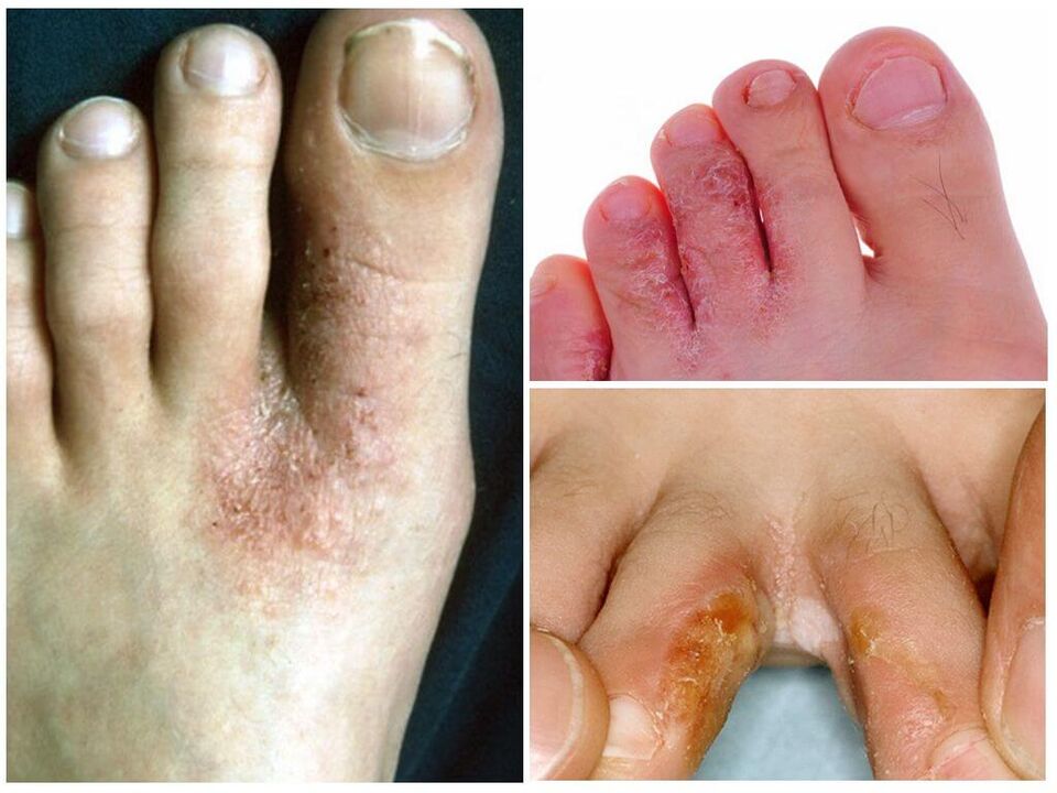 Interdigital Mykose