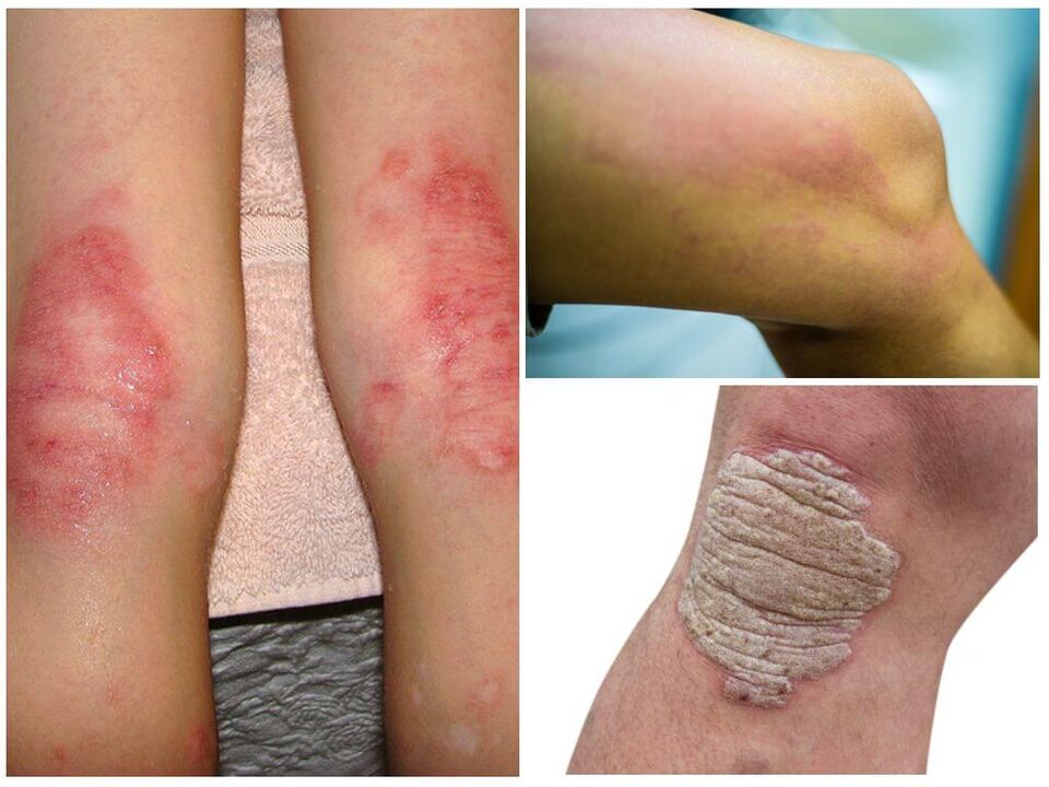 Pilzinfektiounen vun de Knéien