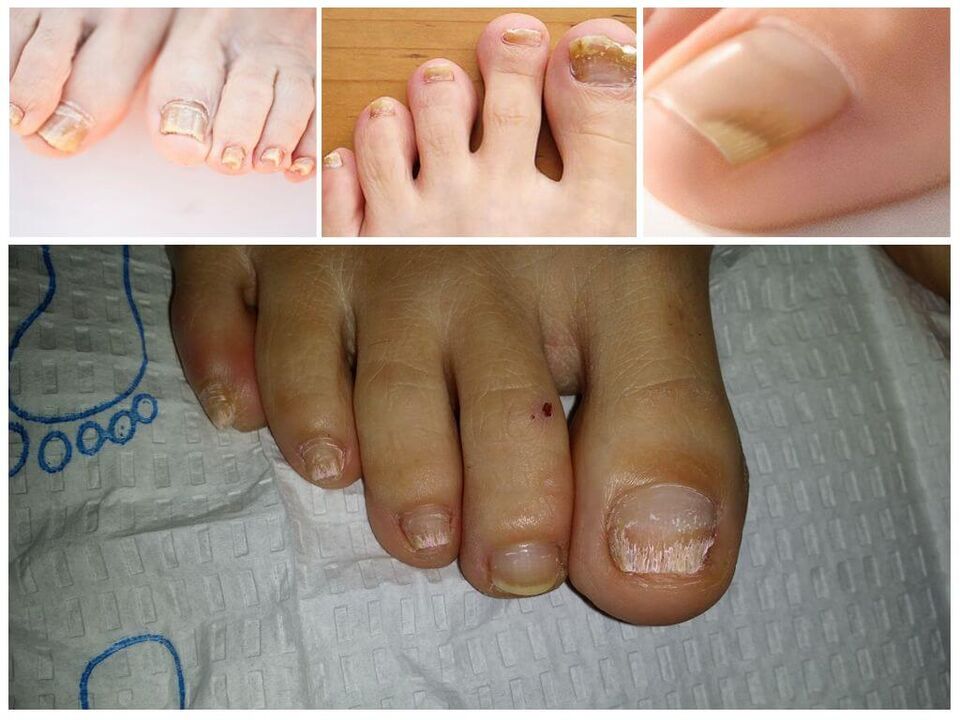 Pilzkrankheeten vun den Nagelplacken