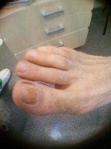 Ufanksstadium vum Nagelpilz vun der grousser Zeh