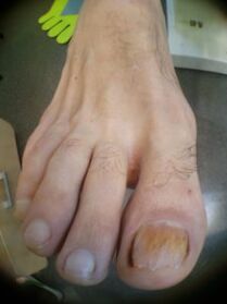 grouss Zehe Nagelpilz