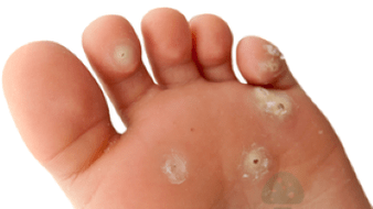 zweet Stuf vun der Pilzinfektioun