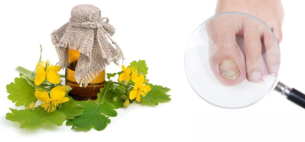 Celandine fir Zehennagelpilz