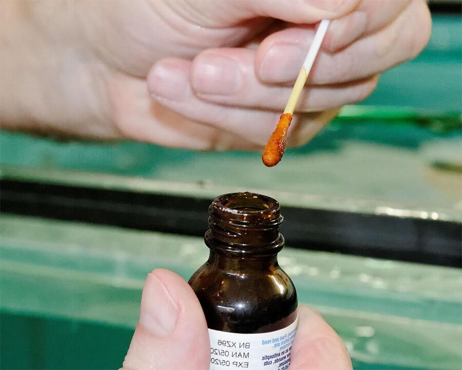 D'Uwendung vun enger Mëschung aus Jod a Celandine Jus op Zehenneel wäert de Pilz lass ginn