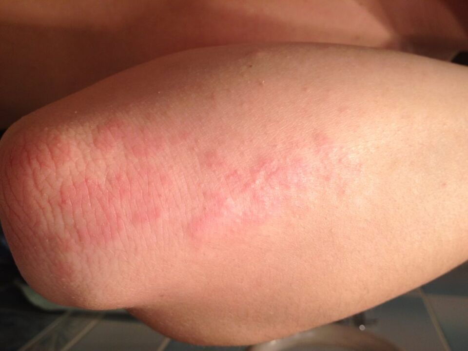 Eng allergesch Reaktioun a Form vun engem Ausschlag op der Haut vum Ielebou no der Uwendung vun engem Tropfen Jus